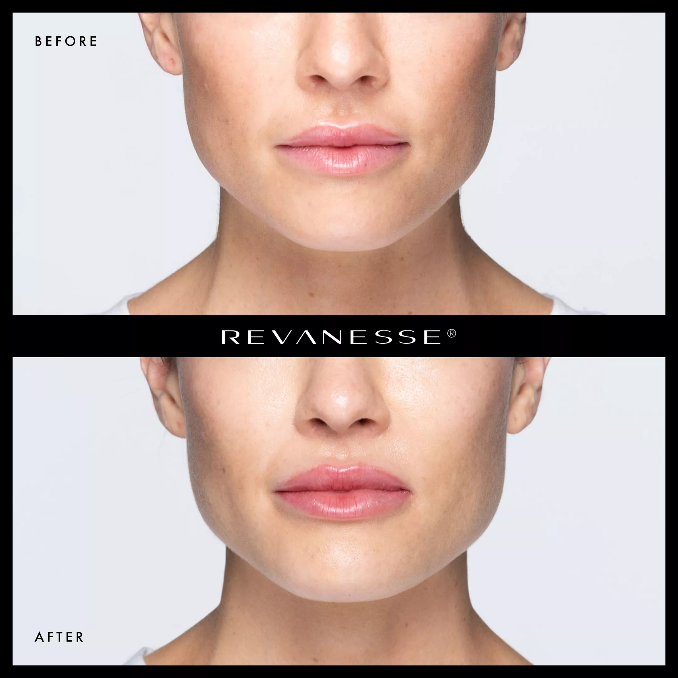 Revanesse 3| Andromeda Medspa | Buford, GA