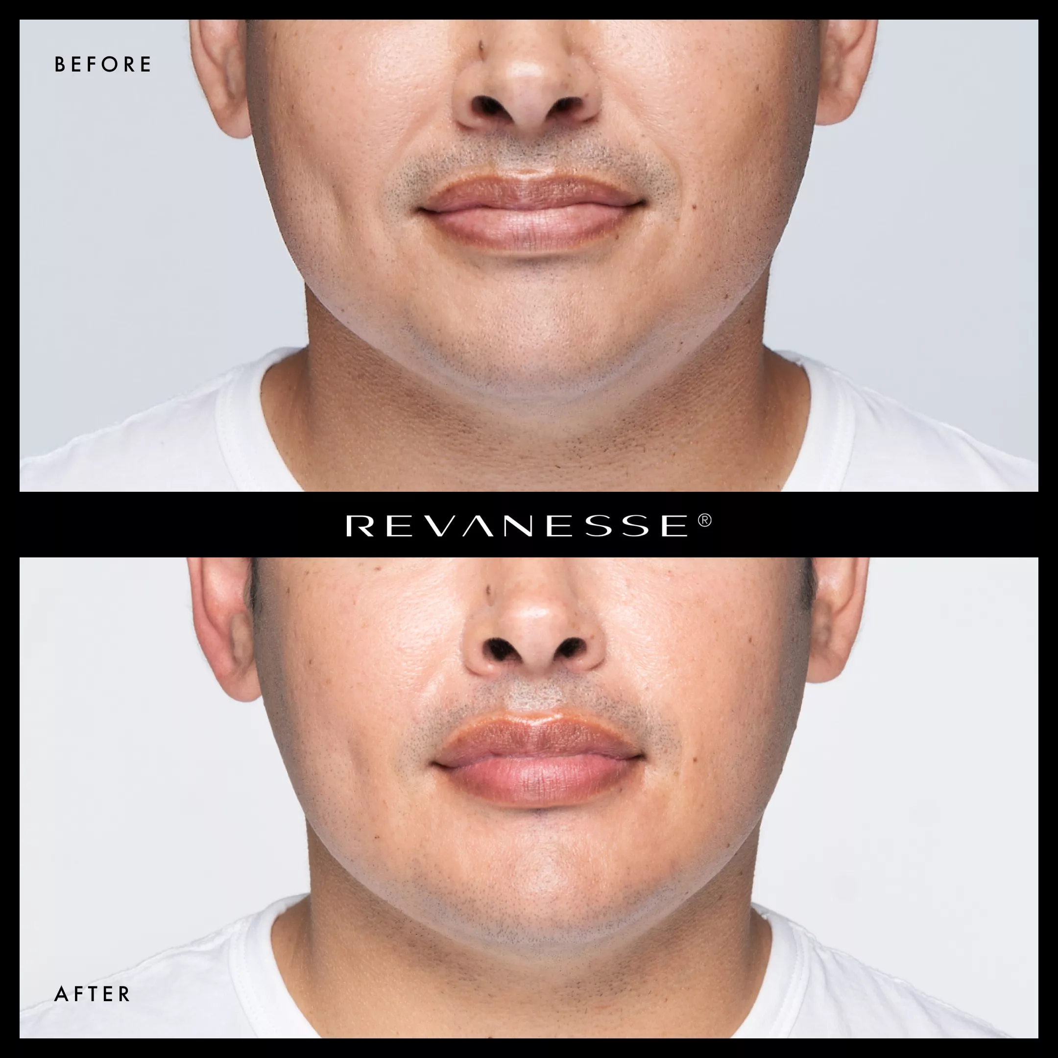Revanesse 2| Andromeda Medspa | Buford, GA
