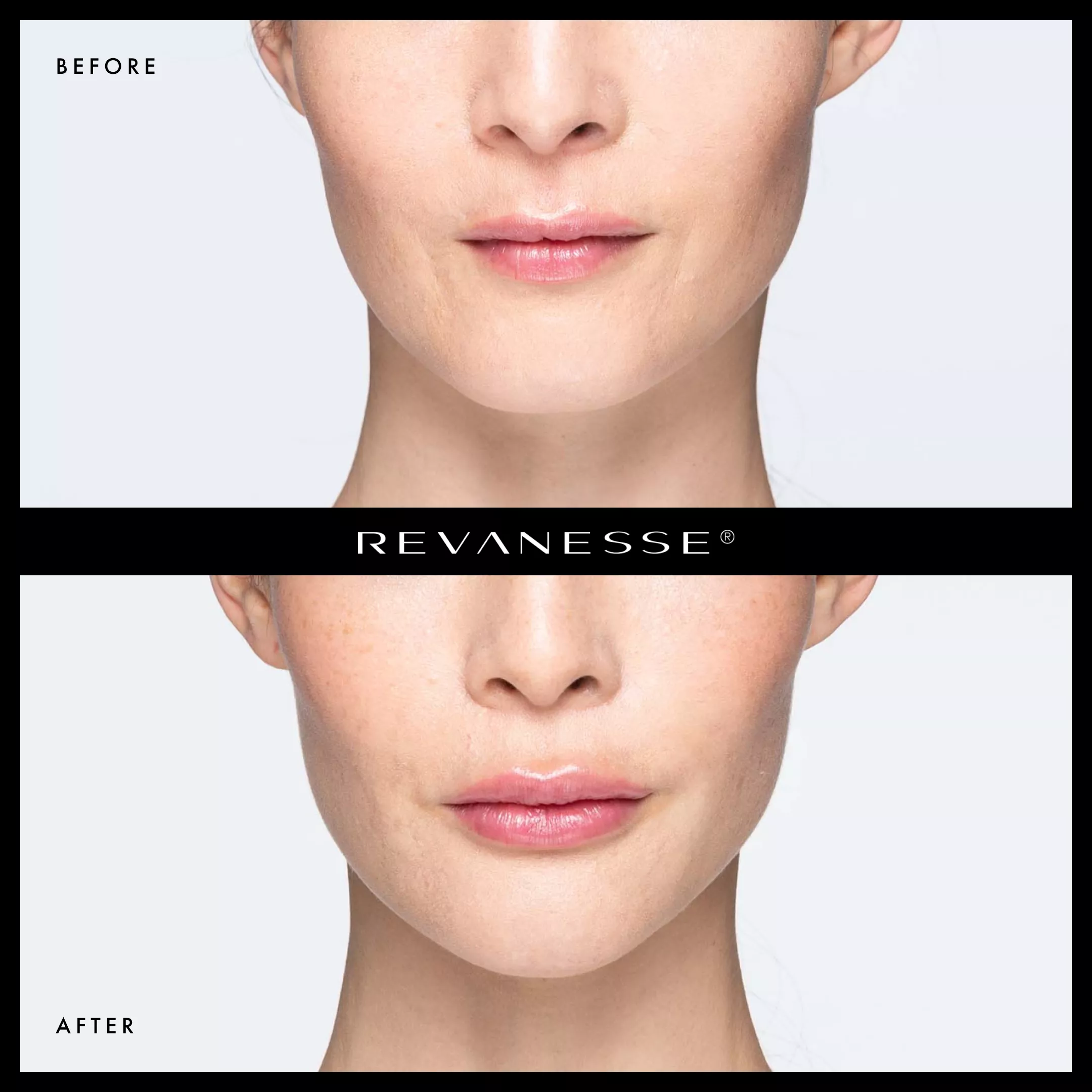 Revanesse 1| Andromeda Medspa | Buford, GA