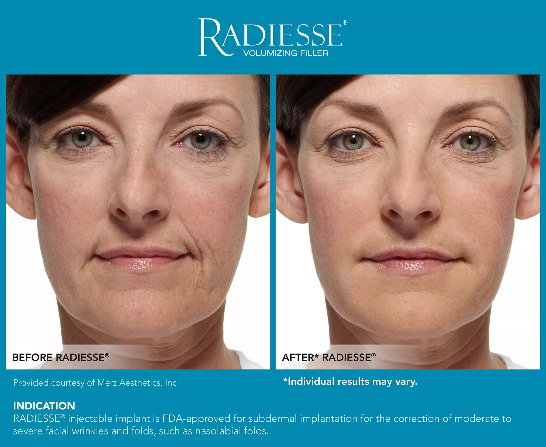 Radiesse 2| Andromeda Medspa | Buford, GA