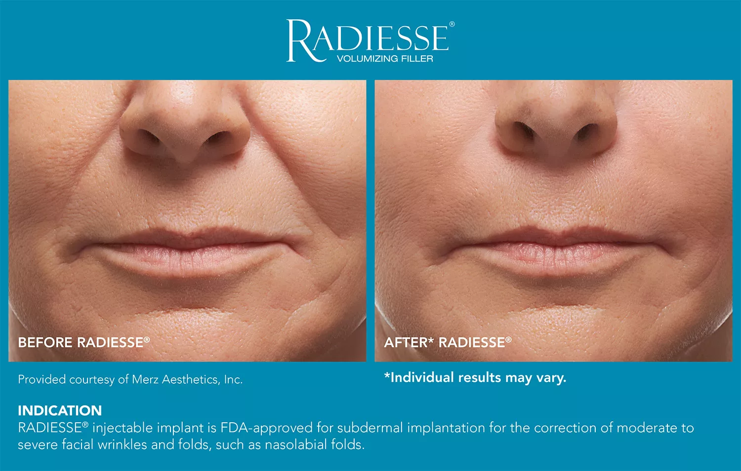 Radiesse 1| Andromeda Medspa | Buford, GA