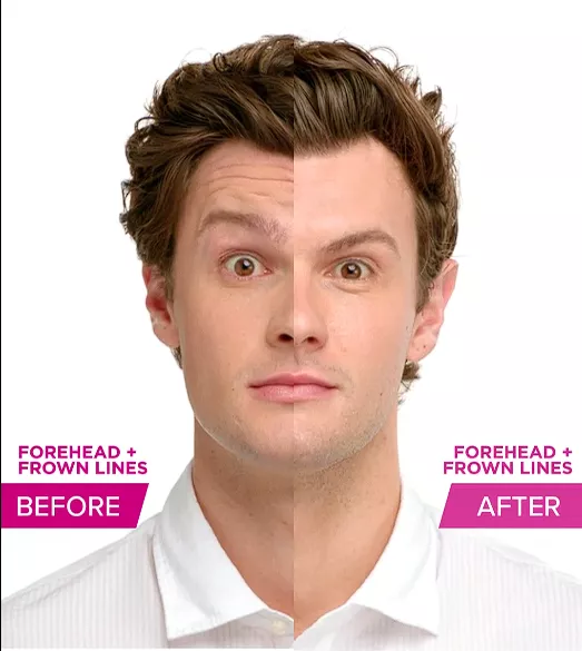 Xeomin BA | Andromeda Medspa | Buford, GA