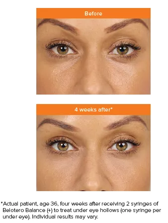 Belotero 1| Andromeda Medspa | Buford, GA