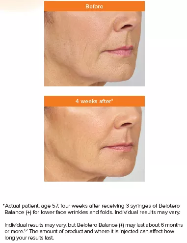Belotero 2| Andromeda Medspa | Buford, GA