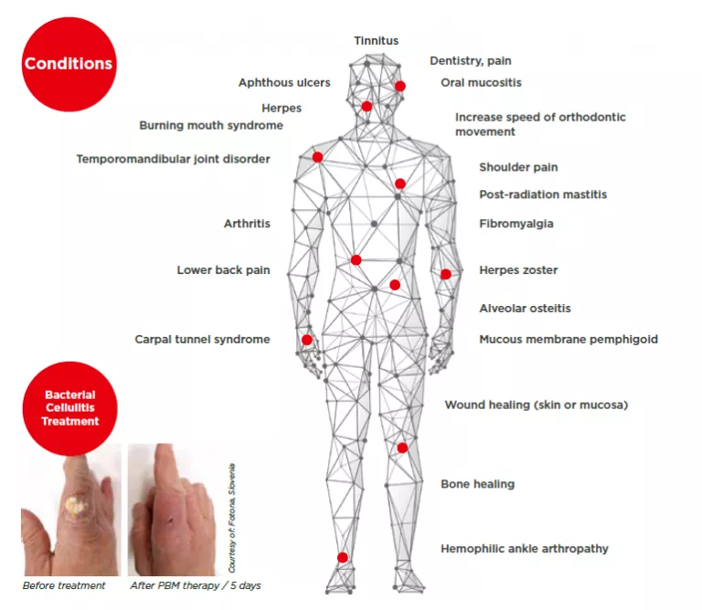 Comfortlase | Andromeda Medspa | Buford Ga