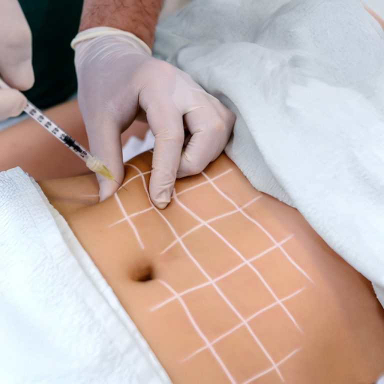 Fat Dissolving Injection | Andromeda Medspa